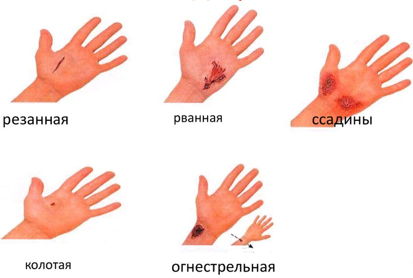 На пальцах есть небольшие ранки с кровью, виды ран и методы их лечения. | Премиум Фото Общими задачами лечения ран являются